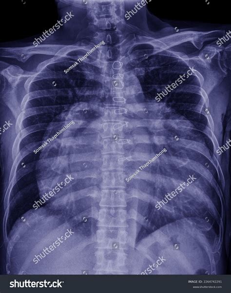 Patients Chest Xray Showed Heart Abnormalities Stock Photo 2264742291 | Shutterstock