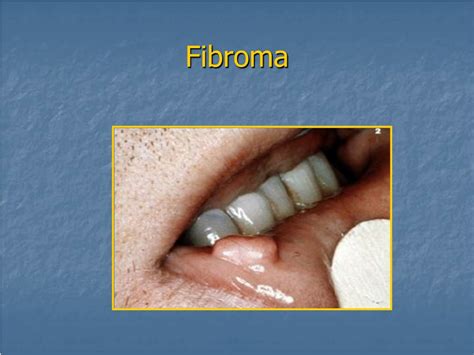 PPT - DISEASES OF THE ORAL CAVITY PowerPoint Presentation, free ...