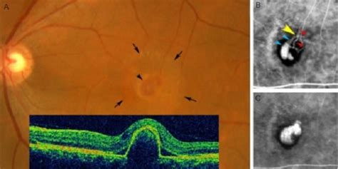 Diagnosis Oklusi Arteri Retina Sentral - Alomedika