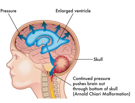 Arnold Chiari Malformation Symptoms - Infoupdate.org
