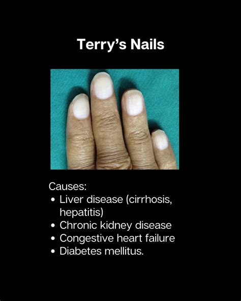 Adrenaline ⚡📚 | Every Doctor Must Know these Nail Changes!!! # ...