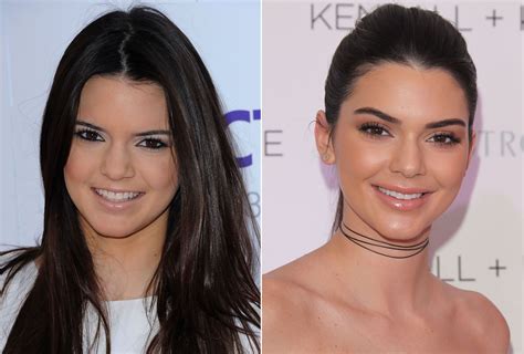 Kendall Jenner, Before and After | Kendall jenner plastic surgery, Kendall jenner lip injections ...
