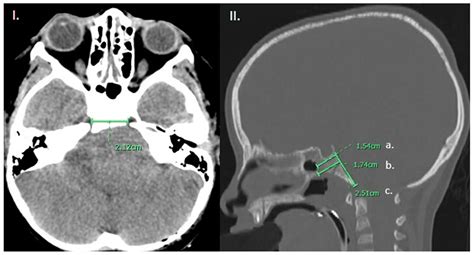Positioning Transclival Tumor-Treating Fields for the Treatment of Diffuse Intrinsic Pontine Gliomas