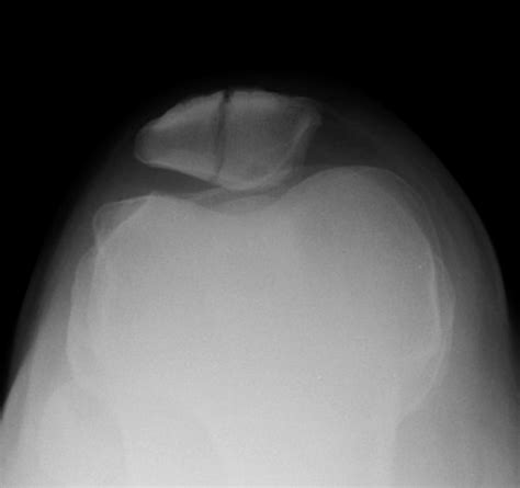 Stress Fracture Patellar Symptoms at Ashton Beazley blog