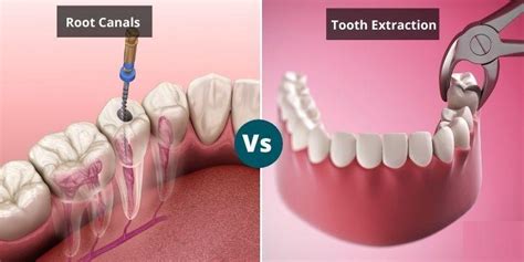 Image result for Pulling Tooth Root
