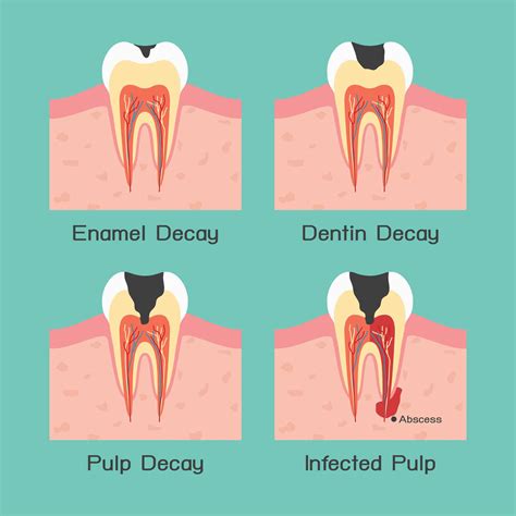 What Is Inside Of An Abscess at Marvin Goff blog