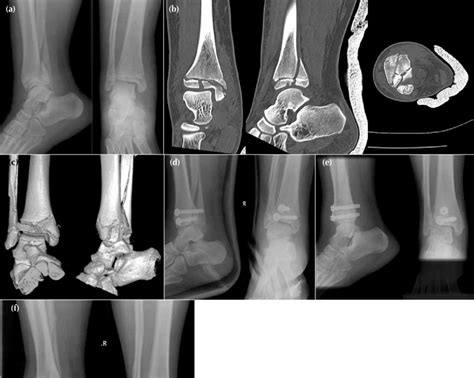 An 11-year-old girl with a 4-part triplane fracture of the left ankle ...