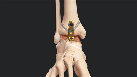 Arthrex - Plantar-Flexed Ankle Fusion Revision Using the Minimally Invasive Ankle Fusion Plate