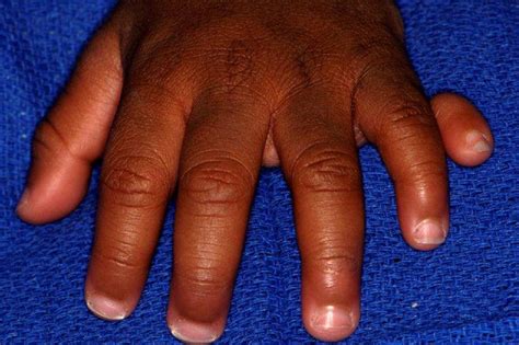 30 Facts About Polydactyly Postaxial With Median Cleft Of Upper Lip ...
