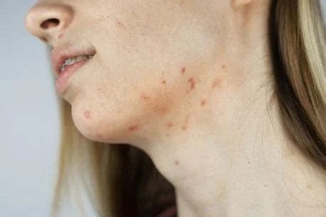 Pictures Of Hormonal Acne | Photo Gallery Of Skin Pictures | The Pink ...