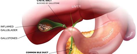 Image result for Gallbladder Cancer