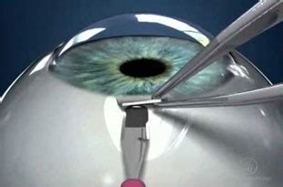 Best Eye Clinic in Greater Noida | Oculus Eye Clinic