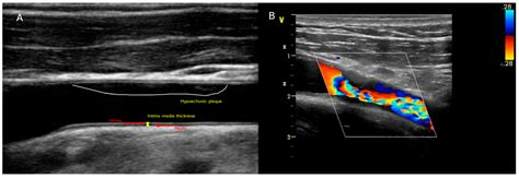 Radiation-Induced Carotid Artery Disease: Pathogenesis, Diagnosis and ...