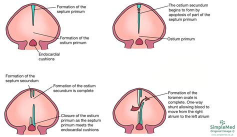 Understanding The Embryological Development Of The Interventricular Septum