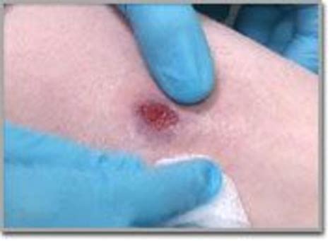 Brown Recluse Spider Bite Treatment