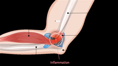 Pain On Inside Of Elbow