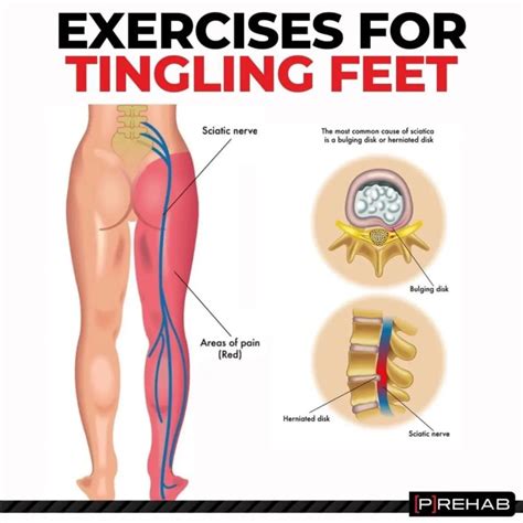 At - Home Fix For Back Pain + Sciatica | 🙋Numbness and tingling in your feet? Pins and needles ...