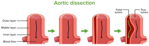 Disseção das Artérias Carótidas e Vertebrais | Concise Medical Knowledge