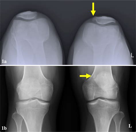 Superior-medial pole of the bipartate patella