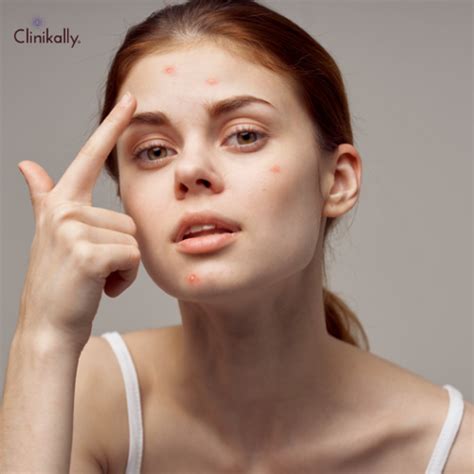 Differin Gel Acne Treatment: How to Use & More | Clinikally