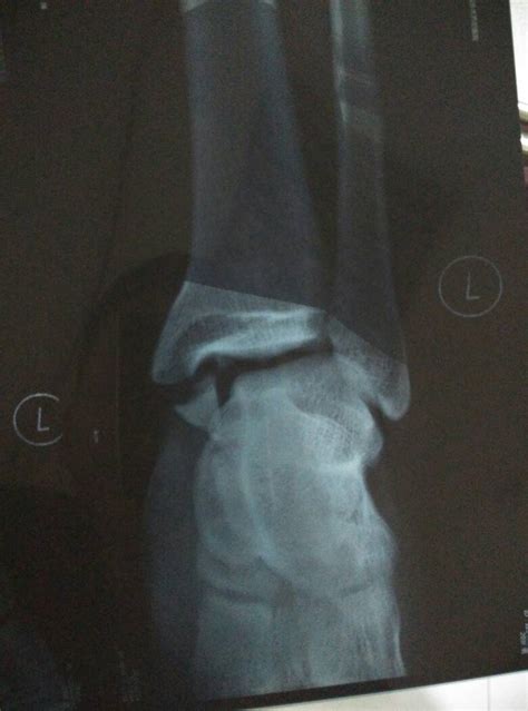 左脚内踝骨骨折，目前钉了钢钉我这个多久可以下地，我前面老人家粉碎性骨折两个月都可以走路了。 图是_百度知道