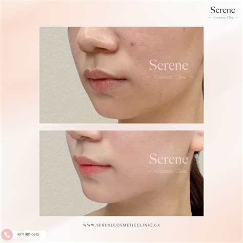 Salmon DNA Injections | Exosome | Toronto Clinic