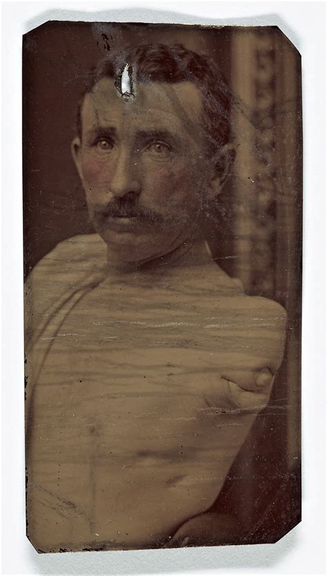 Civil War Amputation Process