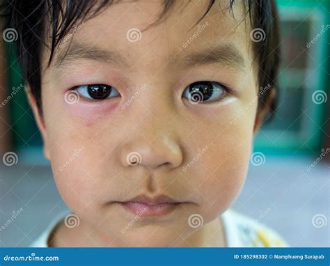 Close Up Face of Asian Child Boy Have Swell Allergic Eye from Insect ...