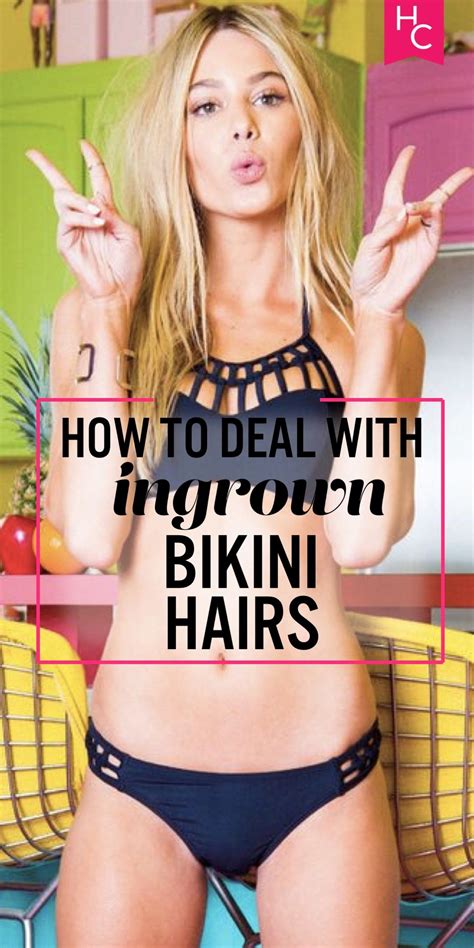 Removing Ingrown Hair On Bikini Line at Stella Prell blog