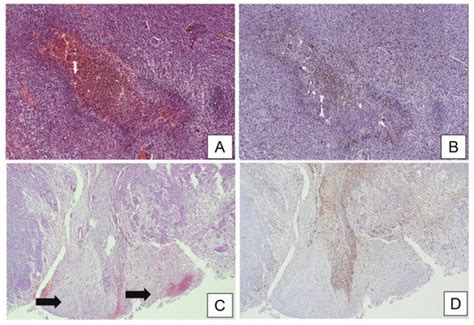 Peritumoral Microenvironment in High-Grade Gliomas: From FLAIRectomy to ...
