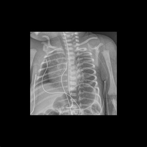 Premature newborn with a new PICC line | Pediatric Radiology Case | Pediatric Imaging ...