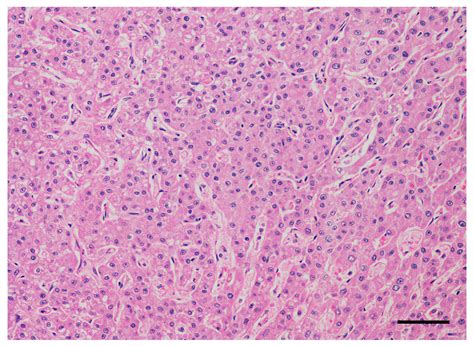 Sorafenib for the Treatment of Unresectable Hepatocellular Carcinoma ...