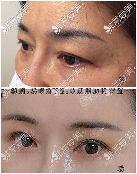 韩国Ucanb整形女士切眉手术+后眼角下至+眼底脂肪再配置对比照片-非常爱美网