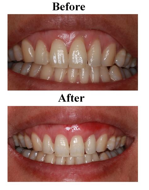 Gum and Bone Grafting in Kelowna | Gum and Bone Grafting Near You