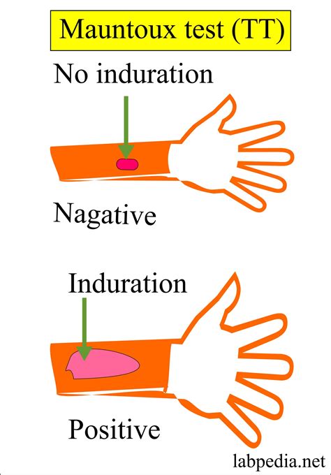 Mycobacterium Tuberculosis:- Part 2 - Mantoux test, TT, Tuberculin skin ...