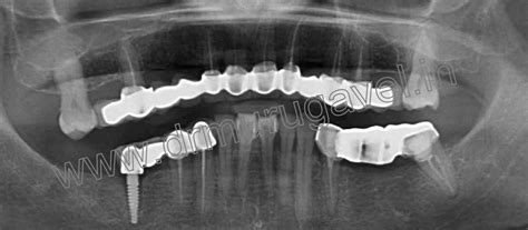 » upper full mouth reconstruction with dental implants in India