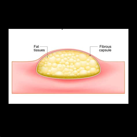 Laser & Open Lipoma Surgery Cost in Hyderabad | Lux Hospital