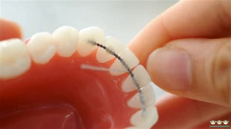 Image result for Floss Threader Fixed Retainer