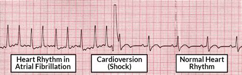 Image result for What Does Synchronized Cardioversion Do