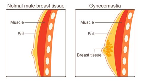 MedfinA complete Look at the Types of Gynecomastia Tissue - Medfin