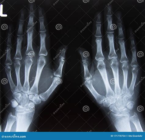 Carpal bones Human X Ray stock photo. Image of clinical - 171770754
