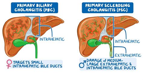 Video: Primary biliary cholangitis and primary sclerosing cholangitis ...