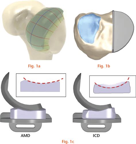Computational wear prediction of insert conformity and material on mobile-bearing ...