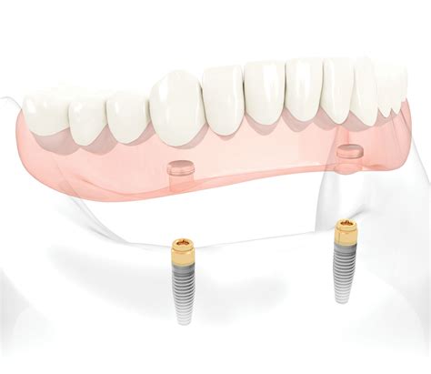 Relining Denture With Locator Attachments at Arthur Dwyer blog