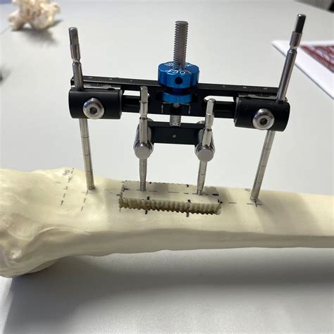 Option bei DFS mit schwerer „small arterial disease“? - Orthopädie ...