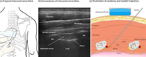 Intercostal Nerve Block Intercostal Nerve Block – Pain Management