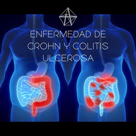 Colitis ulcerosa y enfermedad de Crohn - Clínica Rusca Sagués