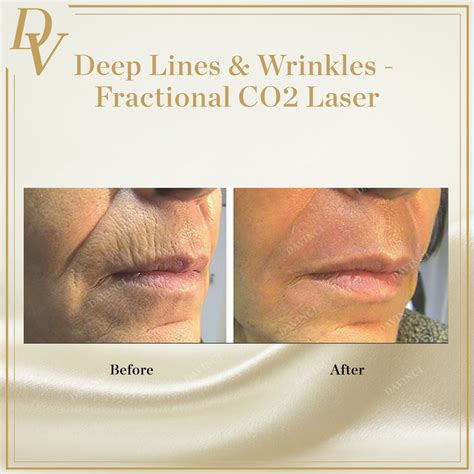 Fractional CO2 Laser Skin Resurfacing Malaysia