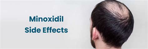 Minoxidil Side Effects: Topical vs Oral side effect & How to Manage