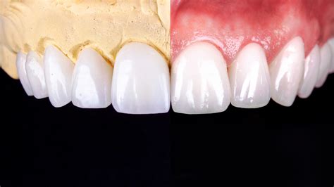 Composite Veneers and 3 exceptional advantages of Composite Veneers - Be Dental